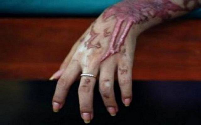 شوہر کے ہاتھوں ایک اور خاتون تیزاب گردی کا شکار