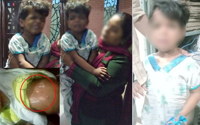 سفاک پھوپھی نےمعصوم بچی کا جسم گرم سلاخوں سے داغ دیا