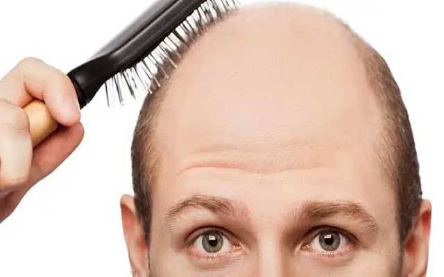 گنجے پن کے شکار مردوں کیلئے انتہائی تشویشناک خبر