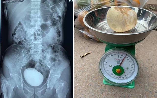 خاتون کے پیٹ سے آدھا کلو سے بڑا پتھر نکل آیا 