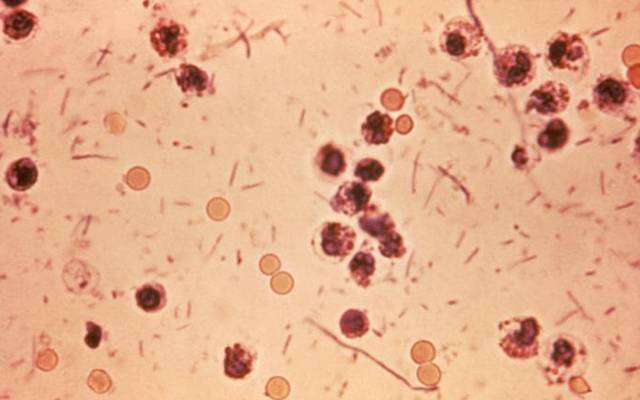 Shigella outbreak sickens