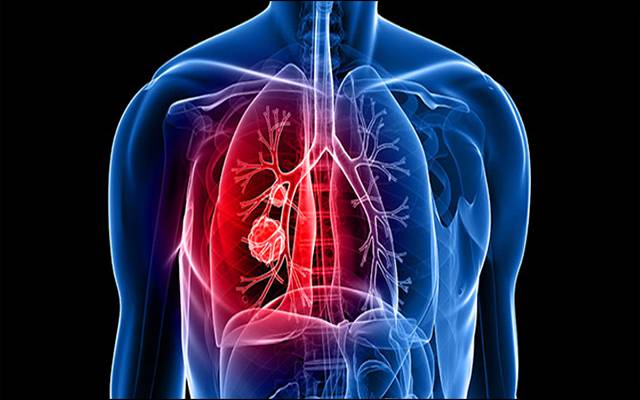 lung cancer symptoms
