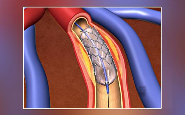 expire heart stent