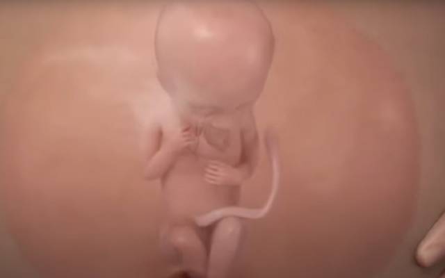 Surgery on Baby in Womb Removes Life-Threatening Tumor on Heart
