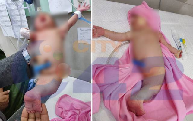 جل پری نما شکل میں بچے کی پیدائش