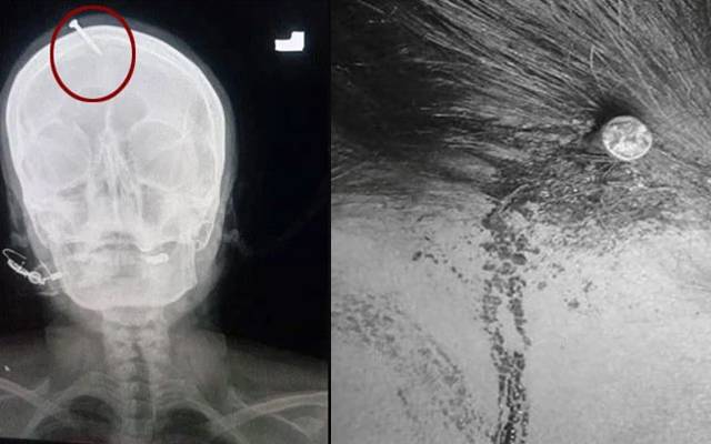 Nail hammered into Pregnant women head