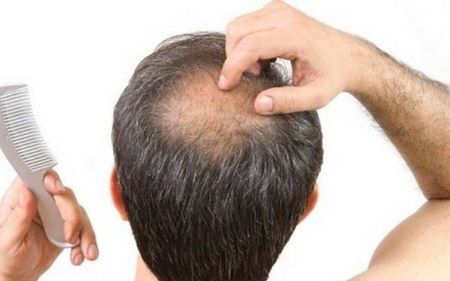 Hair fall treaement