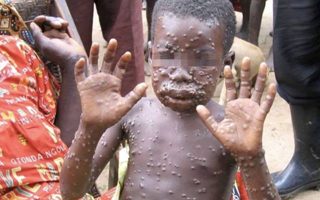 african child affectd by monkey pox