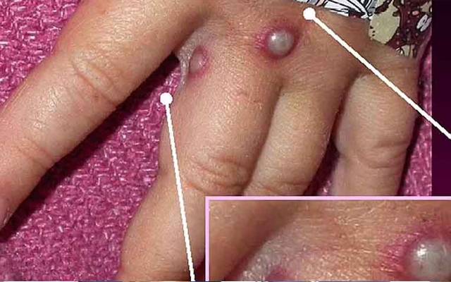 تشویشناک خبر،منکی پاکس نے11 ممالک میں پنجے گاڑھ لیے