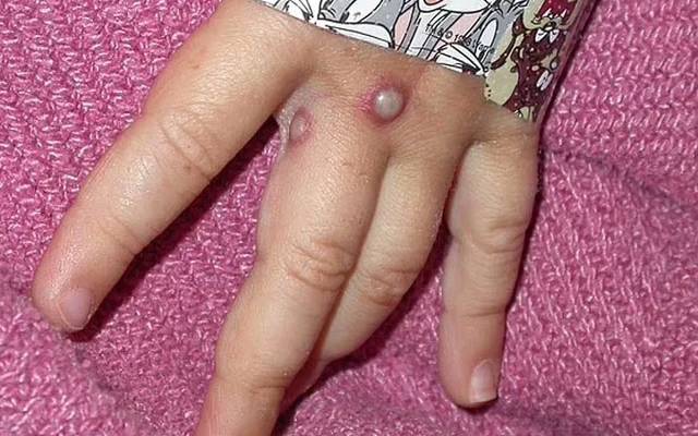 تشویشناک خبر؛منکی پاکس پڑوسی ملک پہنچ گیا