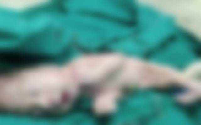  جل پری نما بچے کی پیدائش