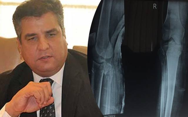 Daniyal aziz X.Ray report