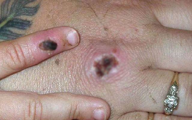 Monkeypox virus