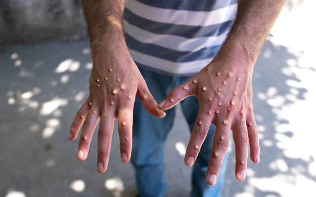 Monkey Pox