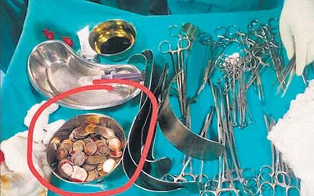 کامیاب آپریشن: شہری کے معدے سے 187 سکے نکال لیے گئے