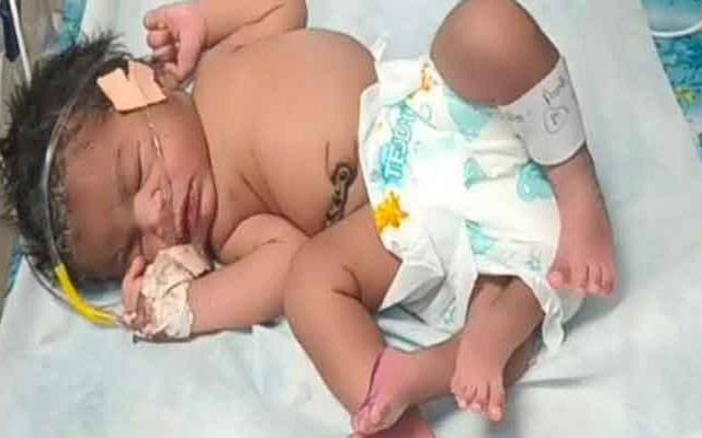  4 ٹانگوں والی بچی کی پیدائش،ڈاکٹرز بھی حیران