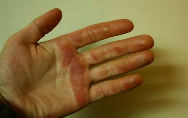 Due to cold weather Risk of frostbite in hands and feet 