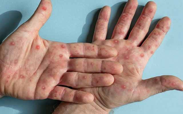 منکی پاکس انسانی جسم میں کیسے داخل ہوتا ہے ؟ تفصیلی اعلامیہ جاری 