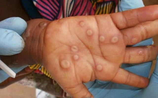 Monkey pox,patient,Karachi,City42
