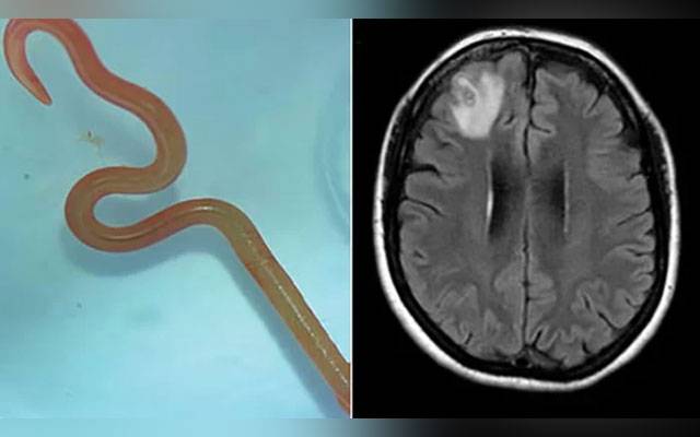 Australia, Round Worm found in the human head, City42