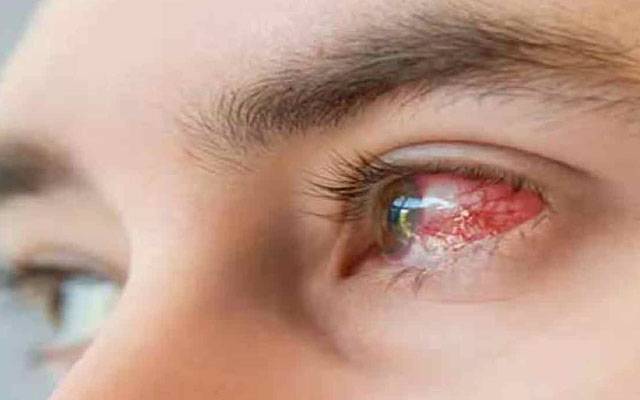 اساتذہ، طلباوطالبات  کو آشوب  چشم سے متعلق  آگاہی  دیں،کمشنر لاہور