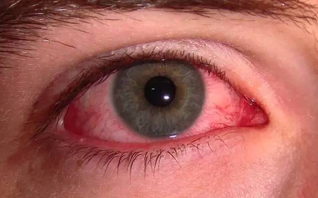  آشوب چشم کے متاثرہ مریضوں کی تعداد میں خطرنک حد تک اضافہ 