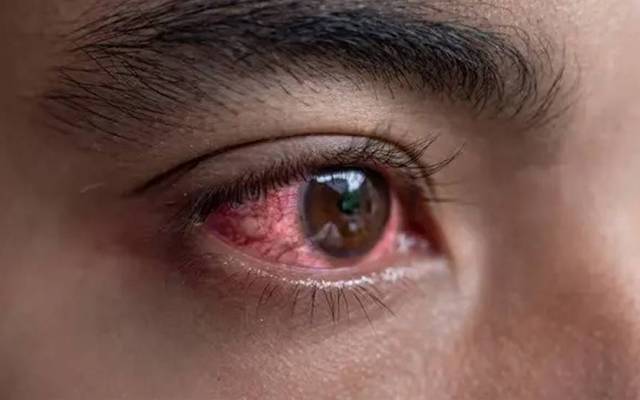  آشوب چشم کی وباءسےمتاثر افراد کی تعداد ایک لاکھ کے قریب جا پہنچی