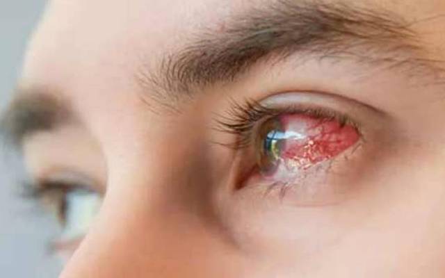  آشوب چشم کب ختم ہو گا ؟ طبی ماہرین نے بتا دیا 