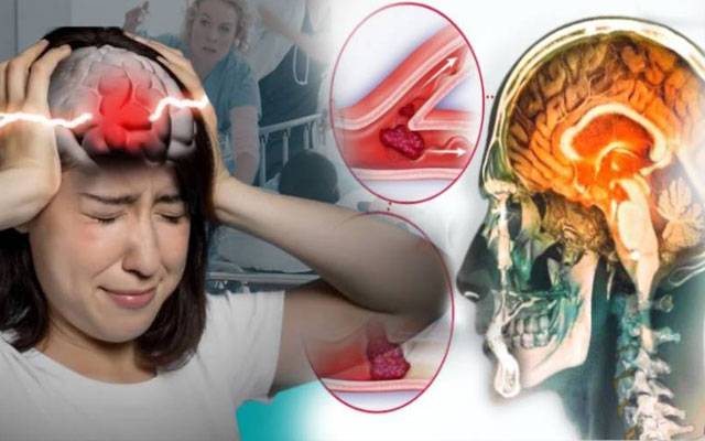 فالج سے ایک کروڑ اموات کا خطرہ