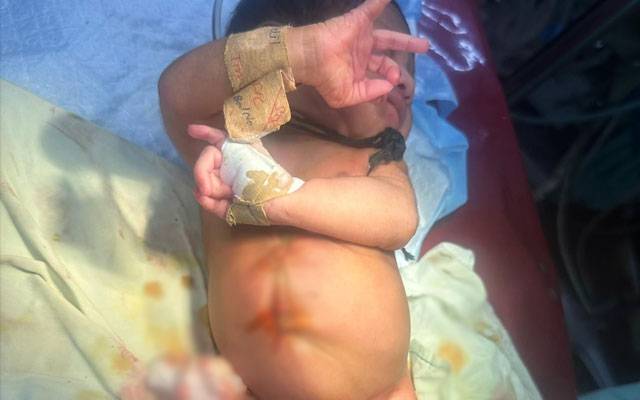  چار بازوؤں ا ور چار ٹانگوں کے ساتھ پیدا ہونے والے بچے کو  سرجری کر کے نارمل بنا دیا گیا
