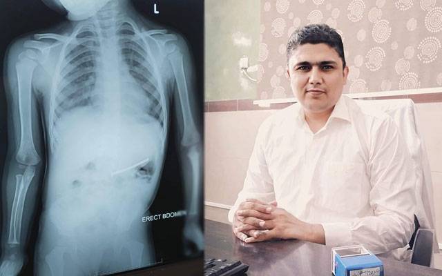  ڈاکٹرکا کارنامہ، بچے کے معدے سے 5 سینٹی میٹر کا کیل بغیرآپریشن نکال دیا