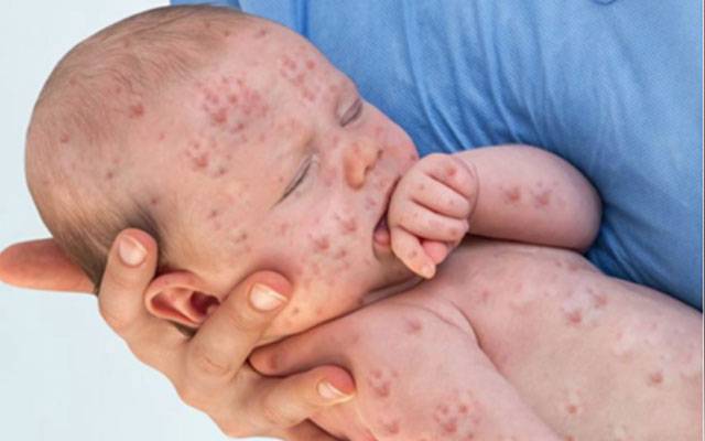 Measles, Multan, City42, Nishtar Hospital, 