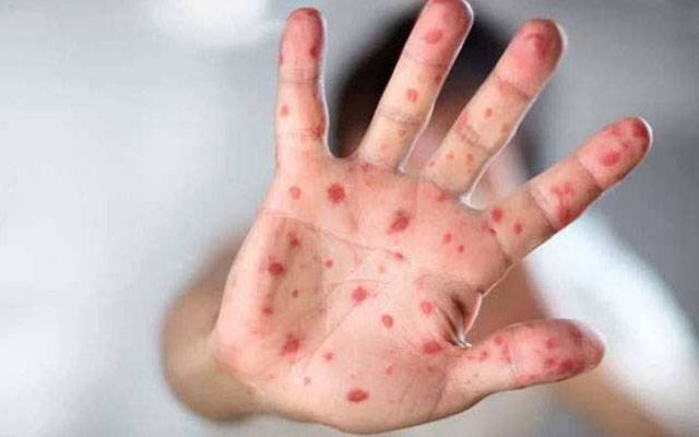  لاہور سمیت  پنجاب بھر میں خسرہ کیسز میں کمی آنا شروع 