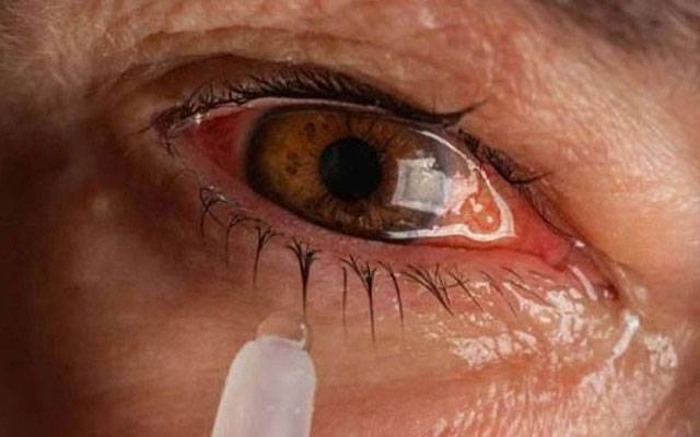  کراچی میں شدید گرمی ، آنکھوں کے امراض میں اضافہ 