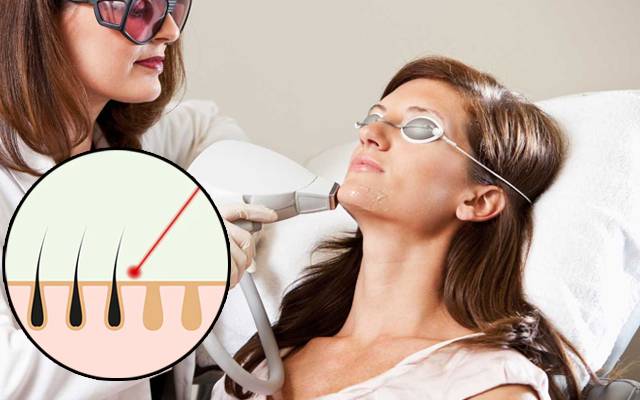 سکین سے ہیئر ریمو کرنے کیلئے لیزر ہیر ٹریٹمنٹ کیسے کام کرتی ہے؟