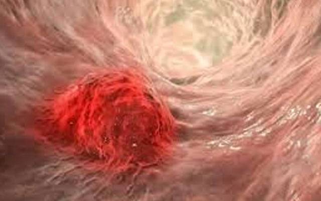 جوان افراد میں تیزی سے پھیلنے والی کینسر کی قسم، بچنے کا آسان طریقہ 