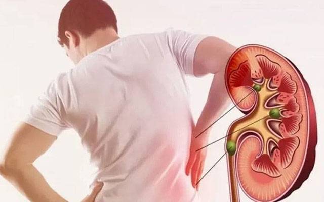 گردے میں  پتھری کیوں بنتی ہے،احتیاطی تدابیر کیا ہیں؟