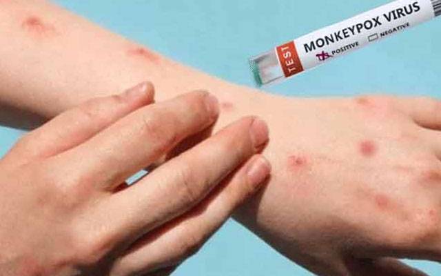 کراچی:جناح ہسپتال میں منکی پاکس کا مشتبہ مریض آئسولیشن وارڈ منتقل