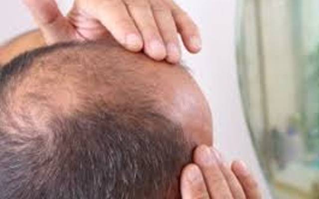مردوں کے گنج پن کے علاج میں اہم دریافت
