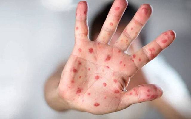 ٹیکساس میں خسرہ کی وباء پھیل گئی  