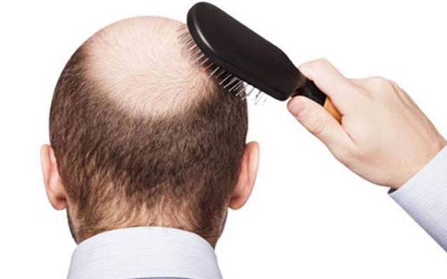 سائنسدانوں نے گنج پن کا  علاج دریافت کرلیا