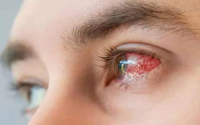 سوزش چشم کا وائرس پھیلنے کا خطرہ، ایڈوائزری جاری