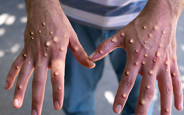  لاہور میں منکی پاکس کا خطرہ ؛ ایک مریض کا ٹیسٹ مثبت