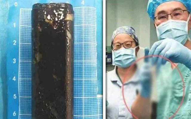 30 سال بعد مریض کے معدے سے لائٹر برآمد، ڈاکٹر دنگ