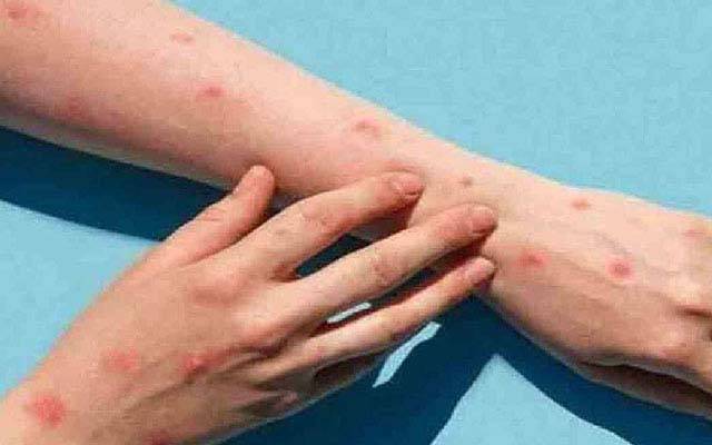  منکی پاکس کی وبابے قابو ;مزید مریض ہسپتال پہنچ گئے 