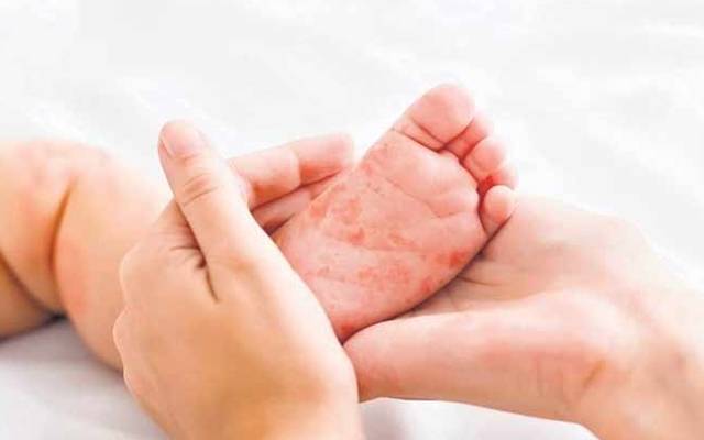  گھوٹکی میں خسرہ کے کیسز میں اضافہ، 3 بچے جاں بحق ہوگئے