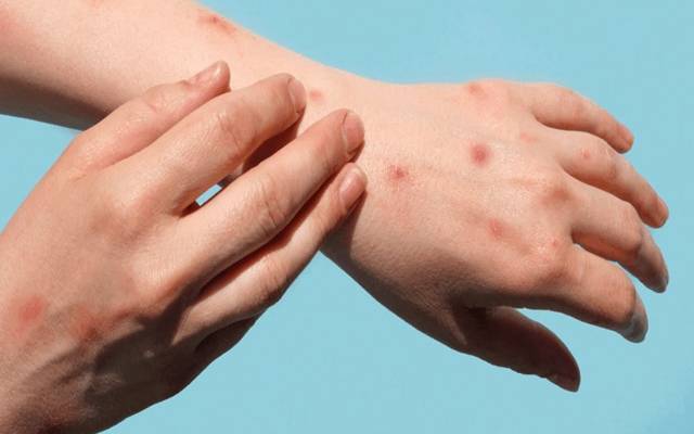  فیصل آباد کے الائیڈ اسپتال میں زیر علاج مریضہ میں منکی پاکس کی تصدیق 