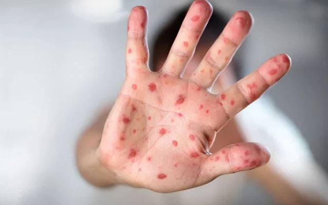 جنوبی وزیرستان میں خسرہ سے 2 بچے جاں بحق