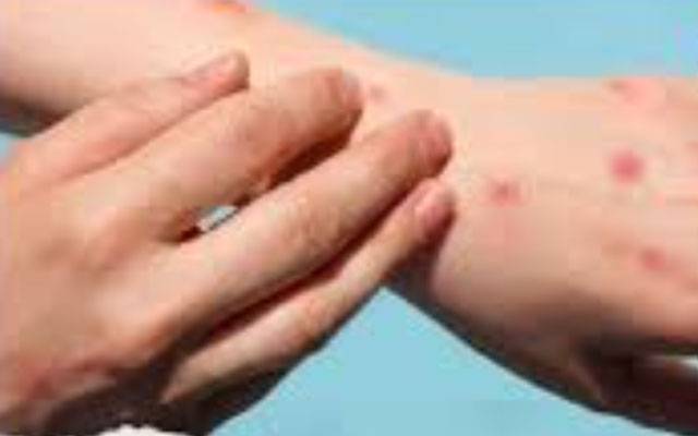 خیرپورمیں منکی وائرس سے مبینہ طور پر ایک بچی جاں بحق