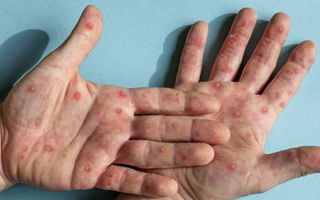  لاہور میں منکی پاکس کے کیسز میں خطرناک حد تک اضافہ
